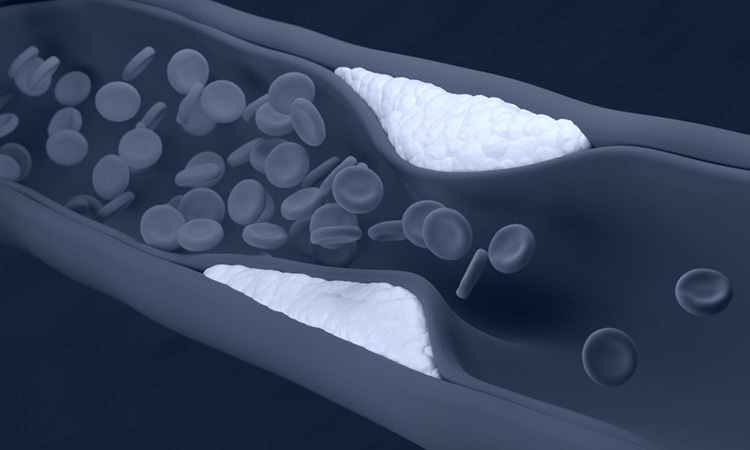 atherosclerosis-vascular-surgeon